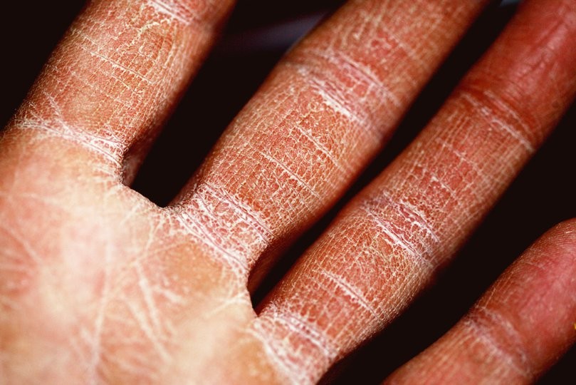 Badly damaged skin on a person’s hand